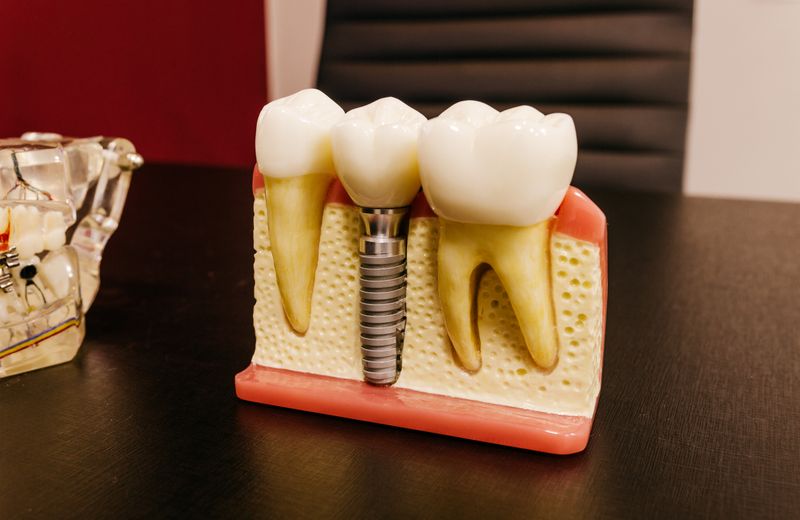 Model of a dental implant screw set between two natural teeth